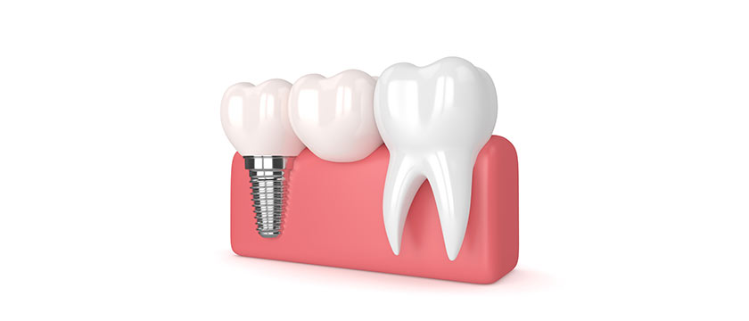 Bone Grafting For Dental Implants: The Essential Information