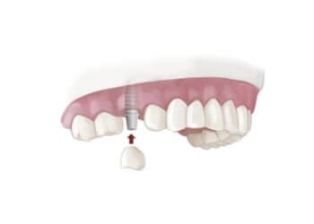 Visit dentalimplantssydneyns.com.au